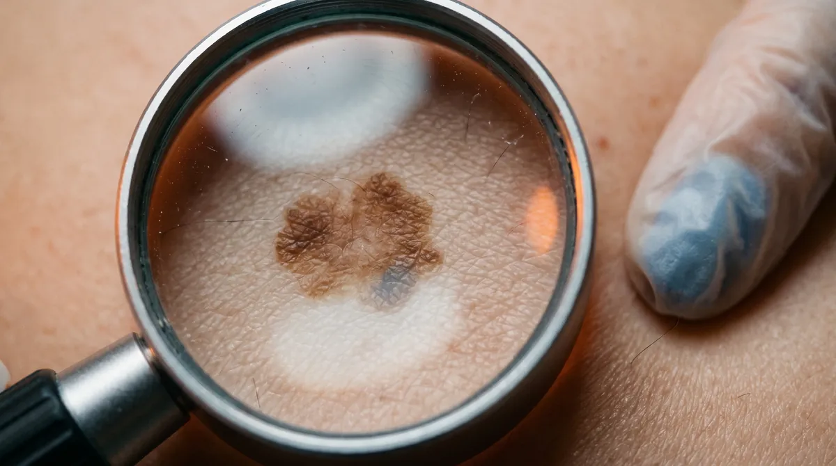 Dermoscopic close-up of a mole used to test AI skin cancer detection models